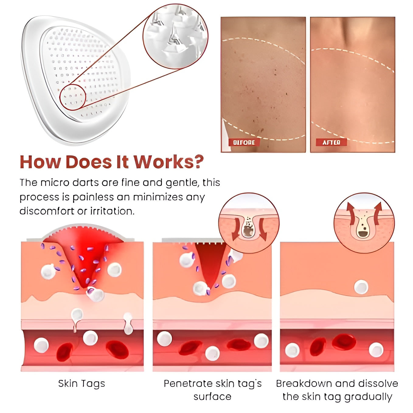 Skin Tag Remover Patch (144 Patches)