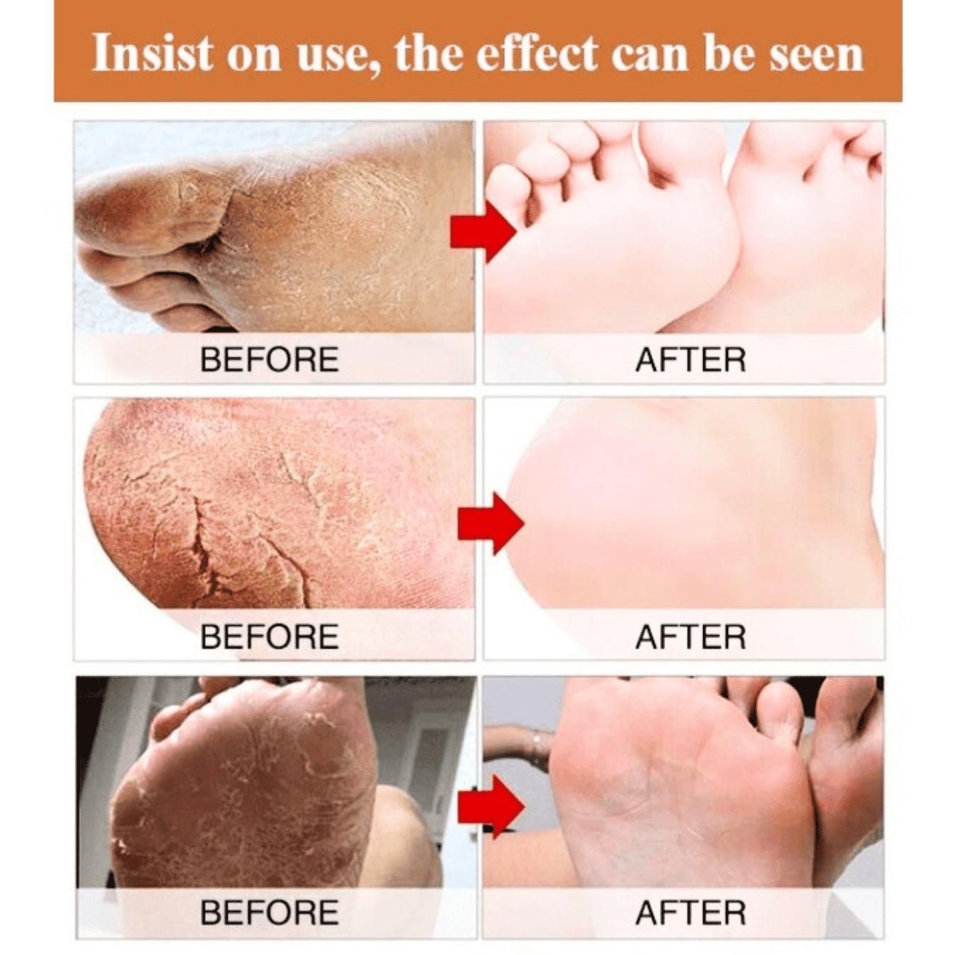 Healing Foot Cream – Cracked Heels & Dry Skin Relief (200 ml)